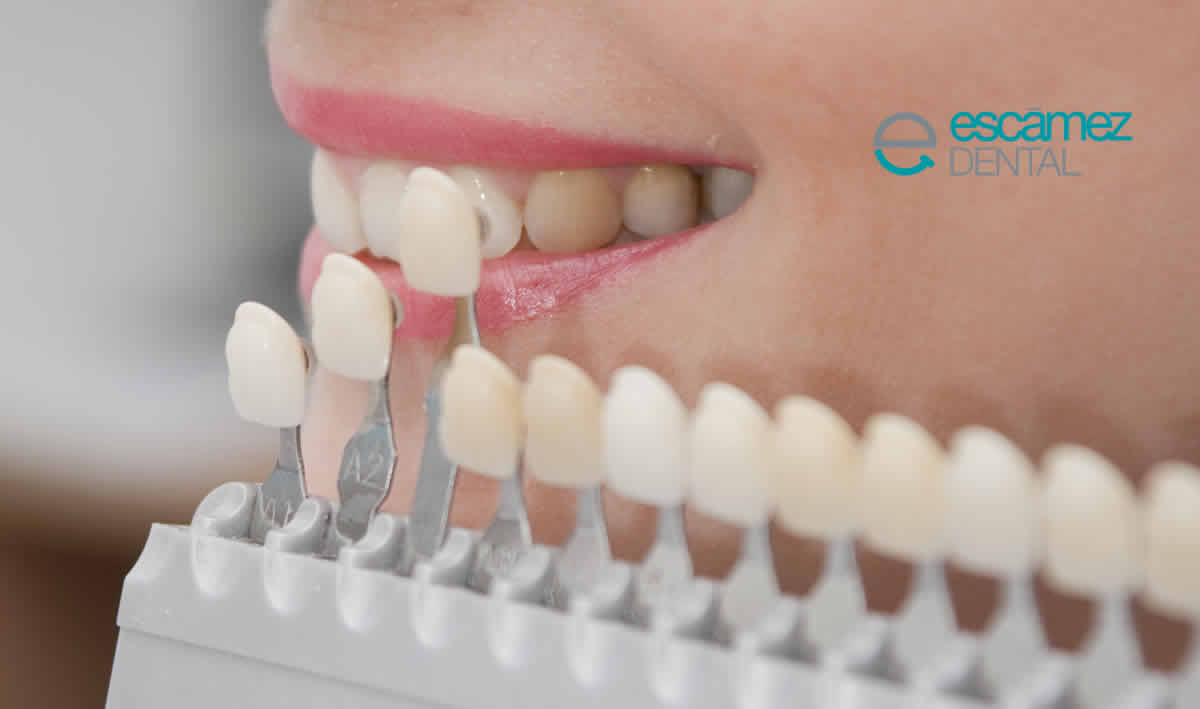 Carillas dentales de porcelana: Todo lo que necesitas saber